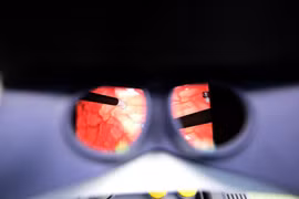 Vỡ bàng quang do ngã xe máy sau cuộc nhậu