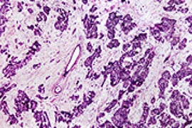 Tìm ra cách phát hiện sớm ung thư di căn từ vú sang phổi