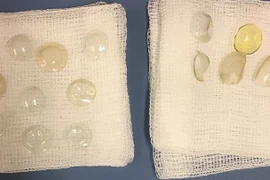 Bác sĩ hoảng hồn tìm thấy 27 miếng kính áp tròng trong mắt bệnh nhân