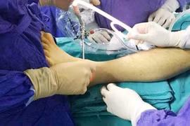 Lần đầu tiên nội soi khớp cổ chân bệnh lý hiếm gặp