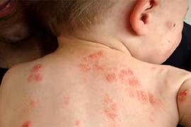 6 bệnh ngoài da hay gặp ở trẻ mùa nắng nóng