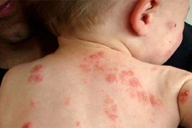 6 bệnh ngoài da hay gặp ở trẻ mùa nắng nóng