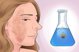 Bỏng nặng khi bị hóa chất tẩy rửa bồn cầu văng trúng