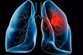 Đây chính là 10 bệnh ung thư đàn ông Việt mắc nhiều nhất