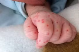 Dấu hiệu dễ nhận biết khi bị bệnh sốt xuất huyết 