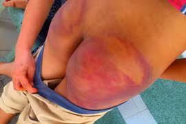 Thân thể bé trai 11 tuổi rướm máu, lở loét vì bị thầy chùa đánh đập dã man