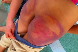 Thân thể bé trai 11 tuổi rướm máu, lở loét vì bị thầy chùa đánh đập dã man