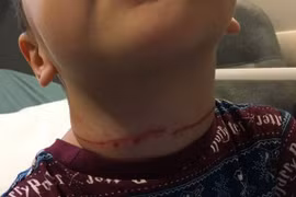 Bé trai 3 tuổi suýt bị thắt cổ đến chết vì lấy thứ này làm vòng cổ