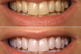 Răng trắng nhanh như sứ với mẹo đơn giản bằng baking soda