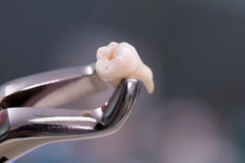 Nhổ 20 chiếc răng, người phụ nữ hôn mê 9 ngày rồi tử vong