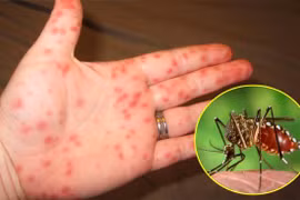 Đã có 6 người tử vong do sốt xuất huyết 