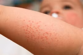 Nắng nóng gặp rôm sảy đã có bài thuốc dân gian trị bệnh