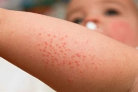 Nắng nóng gặp rôm sảy đã có bài thuốc dân gian trị bệnh