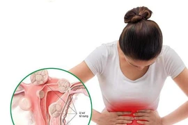 Phẫu thuật u xơ tử cung nếu các triệu chứng bệnh nghiêm trọng