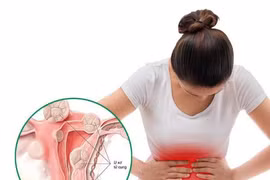 Phẫu thuật u xơ tử cung nếu các triệu chứng bệnh nghiêm trọng