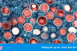 Người nhiễm virus Mpox gây bệnh đậu mùa khỉ nên đi xét nghiệm HIV