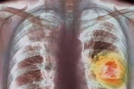 Ung thư phổi xâm nhập, tàn phá cơ thể như thế nào? 