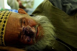 Sốc: Bệnh “ăn thịt người” lan tràn khắp Trung Đông