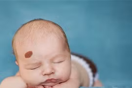 Vết bớt là bằng chứng của hiện tượng luân hồi?