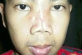 Chàng trai có khuôn mặt "dọa ma" vì thẩm mỹ giá rẻ