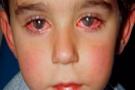 Hãi hùng loại đồ chơi có thể khiến trẻ bị mù vĩnh viễn