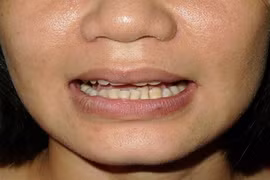 Điều trị u máu đỏ ở miệng bằng laser 