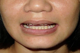 Điều trị u máu đỏ ở miệng bằng laser 