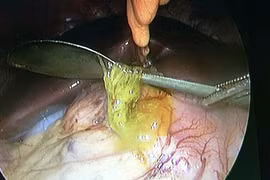 Kinh hãi cả chiếc thìa trong ổ bụng vì uống nước chanh