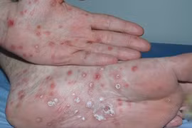 Mẹ ngất xỉu vì con lớp 9 bị phán mắc giang mai 