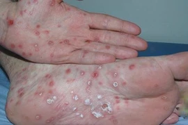 Mẹ ngất xỉu vì con lớp 9 bị phán mắc giang mai 