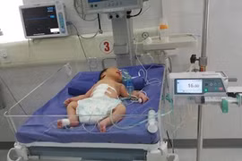 Cứu sống bé sinh non lộ nội tạng ra ngoài thành bụng