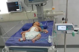 Cứu sống bé sinh non lộ nội tạng ra ngoài thành bụng
