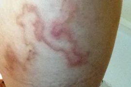 Ác mộng sán bò khắp người vì khoái ăn đồ tái, sống