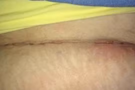 Hy hữu: Sản phụ đau đẻ 36 tiếng, mổ bụng không thấy con