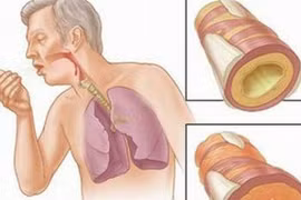 Biểu hiện lạ nguy hiểm trong chữa ung thư phổi