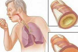 Biểu hiện lạ nguy hiểm trong chữa ung thư phổi