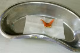 Hy hữu, răng giả rơi xuống ruột già, đâm thủng đại tràng