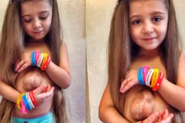 Bé gái 6 tuổi có trái tim bên ngoài lồng ngực