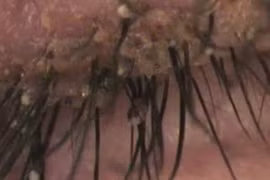 Hoảng hồn hàng trăm con rận mu bám trên mi mắt bé 6 tuổi 