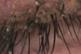 Hoảng hồn hàng trăm con rận mu bám trên mi mắt bé 6 tuổi 