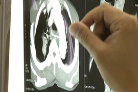 Hy hữu: Cụ ông nguy kịch vì xương gà đâm thấu vùng tim 