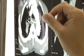 Hy hữu: Cụ ông nguy kịch vì xương gà đâm thấu vùng tim 