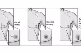 Các dấu hiệu báo động ung thư vú ở nam giới