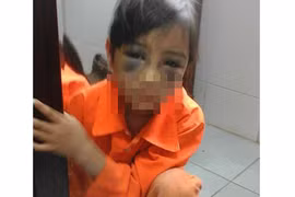 Tin mới vụ bé gái bị đánh tím mắt vì viết chính tả chậm