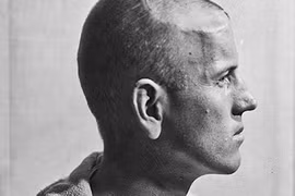 Hình ảnh gây ám ảnh về phẫu thuật não những năm 1900