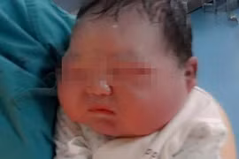 Ăn quá nhiều cháo, sản phụ sinh em bé khổng lồ nặng 6,6kg
