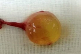 Tá hỏa vì con trai bỗng dưng có 3 tinh hoàn 