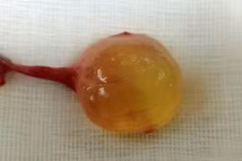 Tá hỏa vì con trai bỗng dưng có 3 tinh hoàn 