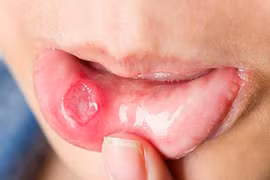 Mẹo trị nhiệt miệng “thần tốc” không cần thuốc 