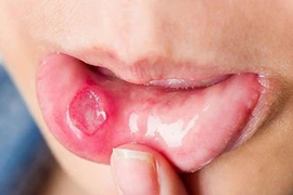 Mẹo trị nhiệt miệng “thần tốc” không cần thuốc 